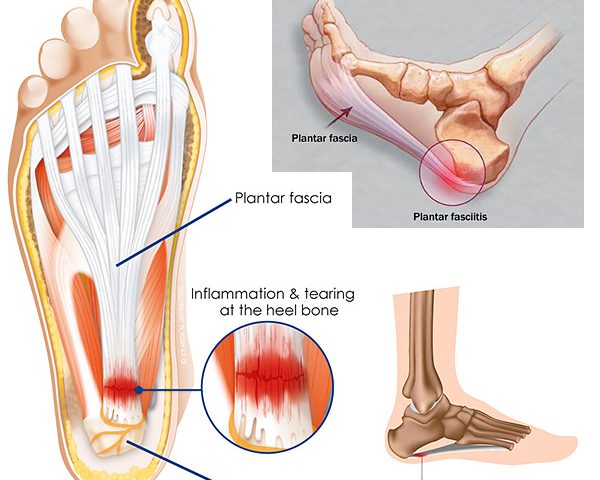 Stretches for Plantar Fasciitis Pain Relief From Your Charlotte Chiropractor